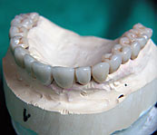 Festsitzender Zahnersatz